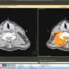 Интерфейс PINNACLE Syntegra — автоматическая мультимодальная регистрация ПЭТ/КТ изображений для планирования лучевой терапии