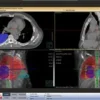 Интерфейс рабочей станции PINNACLE AcQSim — КТ-симуляция с визуализацией анатомических структур