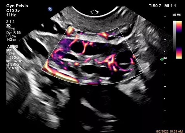 Параметры TI и MI при оценке кровотока яичника на аппарате Philips EPIQ Elite Значения TI и MI в УЗИ