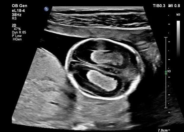 При сканировании структур мозга важно следить за TI и MI, чтобы исключить риски негативного воздействия УЗИ на аппарате Philips EPIQ Elite