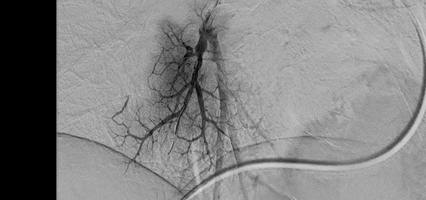Снимок на ангиографе Philips Azurion 7 M20 Визуализация сосудов на ангиографе