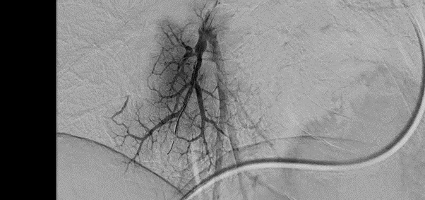 Визуализация сосудов на ангиографе