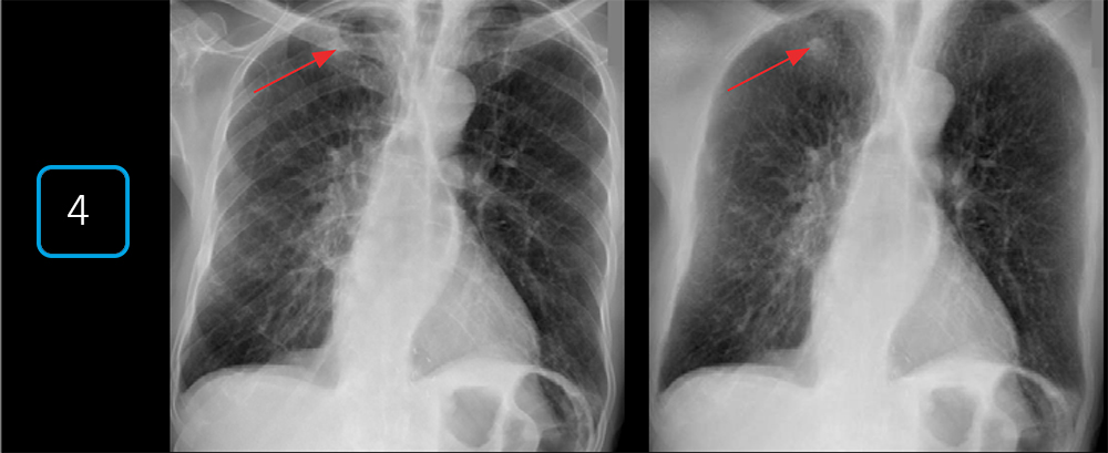 Рентгеновские снимки грудной клетки с технологией подавления костной ткани. Рентгеновские снимки грудной клетки пациента