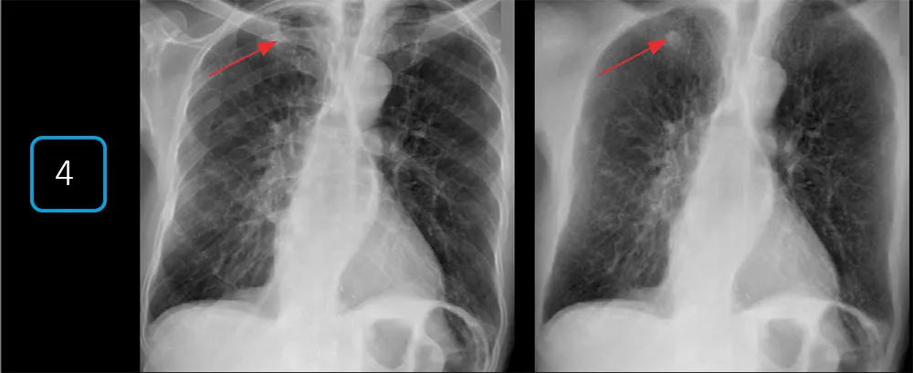 Рентгеновские снимки грудной клетки пациента
