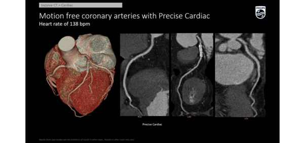 Коронарная ангиография на аппарате Philips Incisive CT. Фото сердца на компьютерном томографе