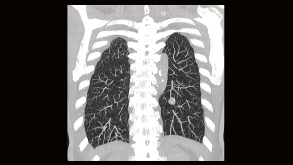 Снимок легких на КТ Siemens SOMATOM go.Now. Изображение легких