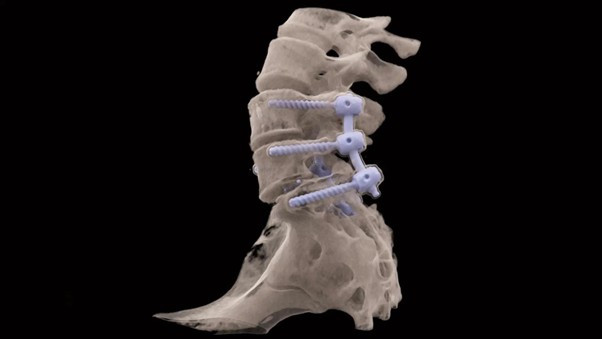 Снимок пояснично-крестцового отдела на Siemens SOMATOM X.Ceed без артефактов от металла. Снимок пояснично-крестцового отдела