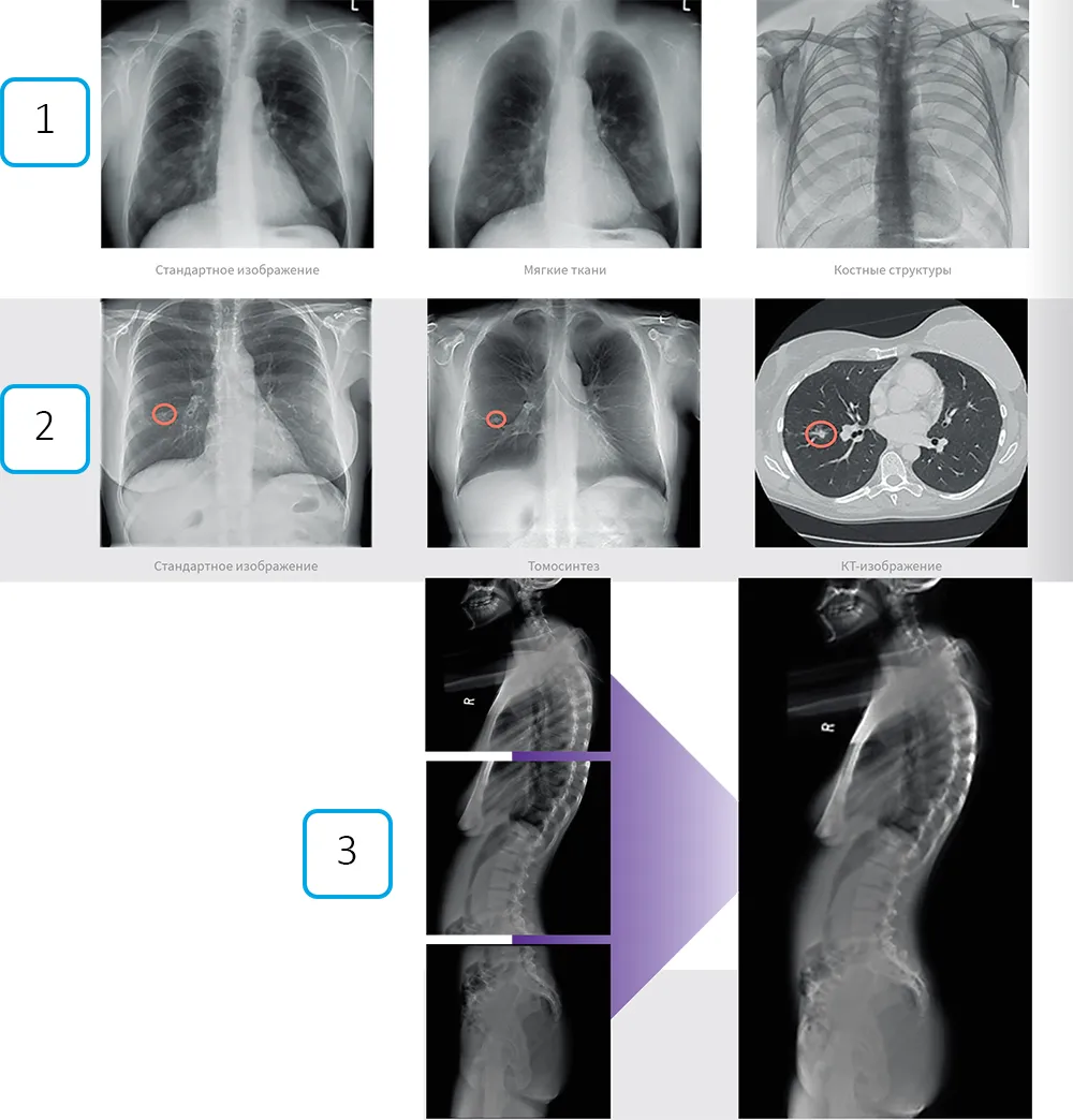 Рентгеновские снимки грудной клетки