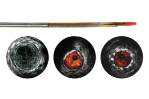 Reconnaissance PV .018 OTW — Цифровой катетер для ВСУЗИ