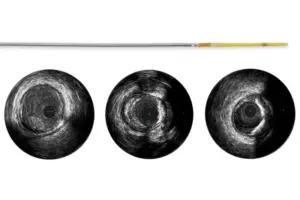 Refinity — Ротационный катетер для ВСУЗИ