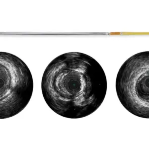 Refinity — Ротационный катетер для ВСУЗИ