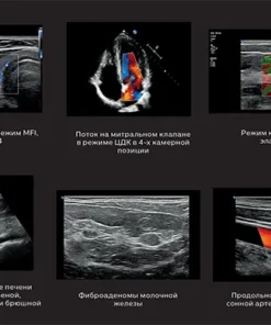 Коллаж УЗИ общая визуализация на Philips 5500: щитовидная железа (MFI), митральный клапан (ЦДК), компрессионная эластография, печень и аорта, фиброаденома, сонная артерия (ЦДК).
