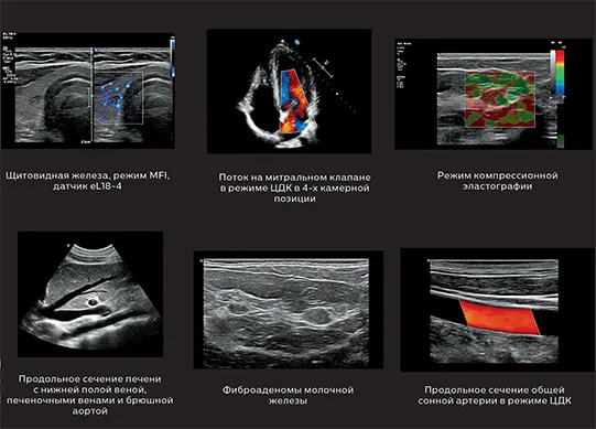Philips_5500_tdpuls-4 Коллаж УЗИ общая визуализация на Philips 5500: щитовидная железа (MFI), митральный клапан (ЦДК), компрессионная эластография, печень и аорта, фиброаденома, сонная артерия (ЦДК).