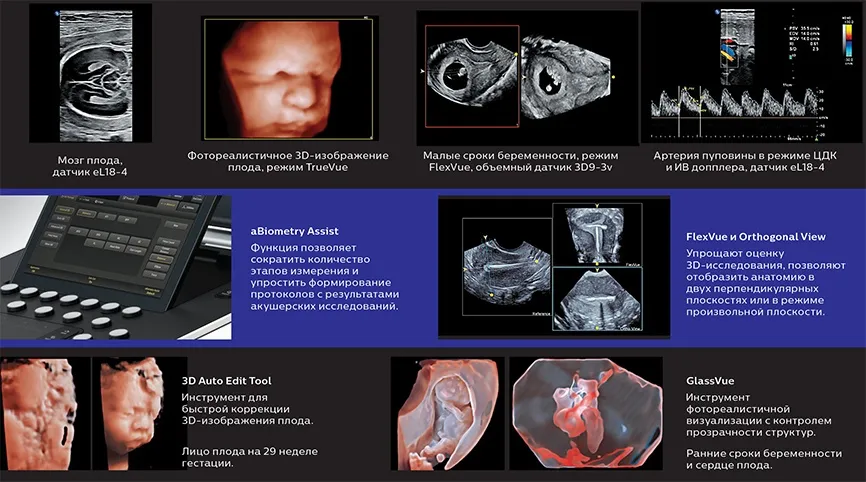 Philips_5500_tdpuls-58 Коллаж УЗИ на Philips 5500: пренатальная визуализация — мозг и 3D-лицо плода, FlexVue, допплер пуповины, инструменты aBiometry Assist, 3D Auto Edit, GlassVue.