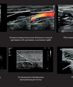 Коллаж УЗ-исследования на месте оказания медицинской помощи на Philips 5500: глазной нерв, бляшка сонной артерии, плечевое сплетение, матка, визуализация иглы, плевра легкого.