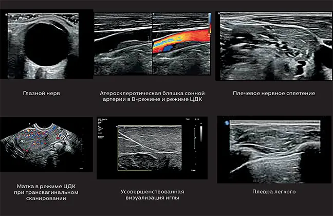 Philips_5500_tdpuls-59 Коллаж УЗ-исследования на месте оказания медицинской помощи на Philips 5500: глазной нерв, бляшка сонной артерии, плечевое сплетение, матка, визуализация иглы, плевра легкого.