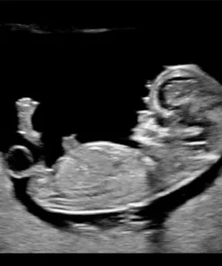 УЗИ плода в профиль на датчике Philips eL18-4 — визуализация головы, туловища и конечностей в акушерском режиме OB Gen